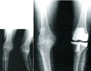 Στην πρώτη ακτινογραφία βαριά οστεοαρθρίτιδα αριστερού γόνατος  με διαταραχή του μηχανικού άξονα (βλαισογονία), στην δεύτερη ακτινογραφία ο ίδιος ασθενής μετά την ολική αρθροπλαστική με υλικά επί παραγγελία (custom  made). 