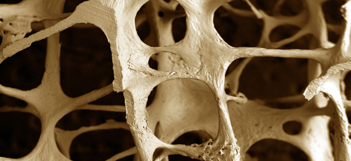 osteoporosis700